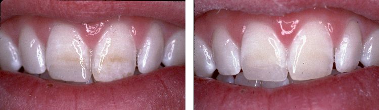 How do I correct a tooth decalcification?